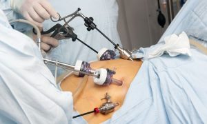 Advantages Undergoing Gastric Bypass Surgery